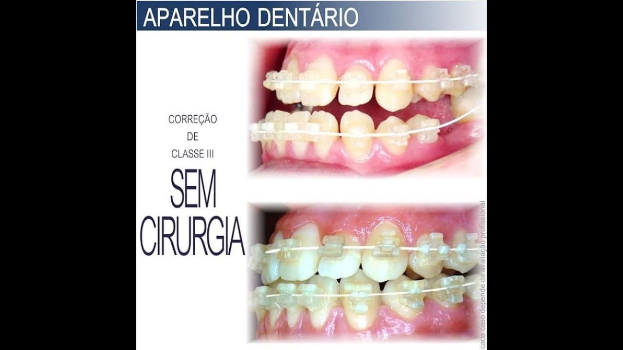 CLASSE III - Correção SEM CIRURGIA de CASOS GRAVES com Aparelho Autoligado