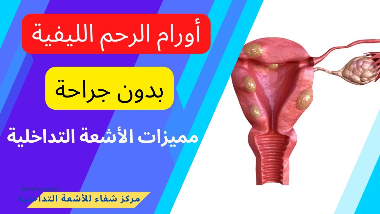 مميزات الاشعة التداخلية فى علاج اورام الرحم الليفية