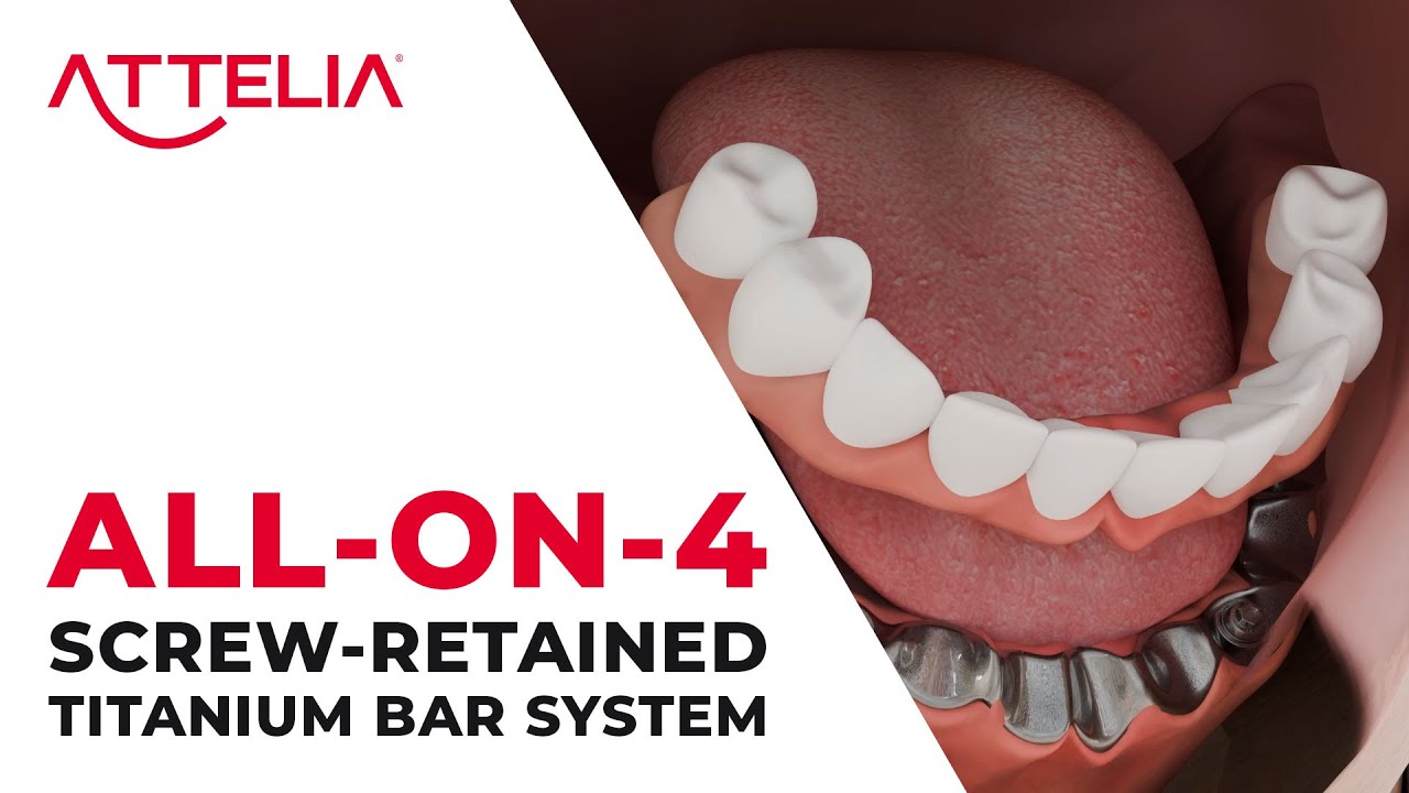 ATTELIA ALL-ON-4 SCREW-RETAINED TITANIUM BAR SYSTEM