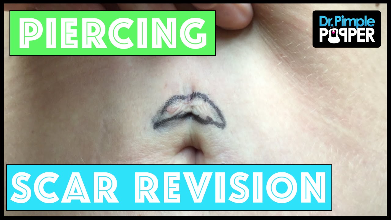 Scar Revision after a Bad Belly Button Piercing