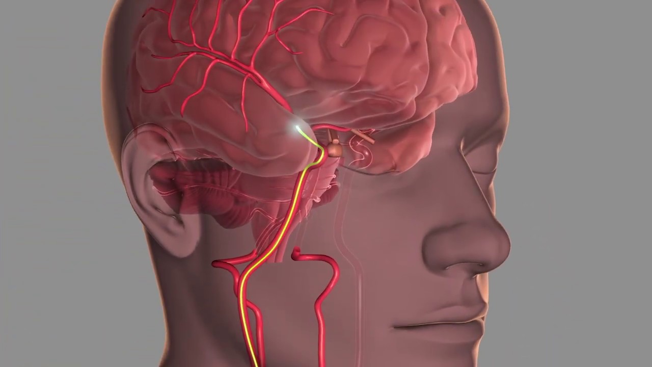 Mechanical Thrombectomy