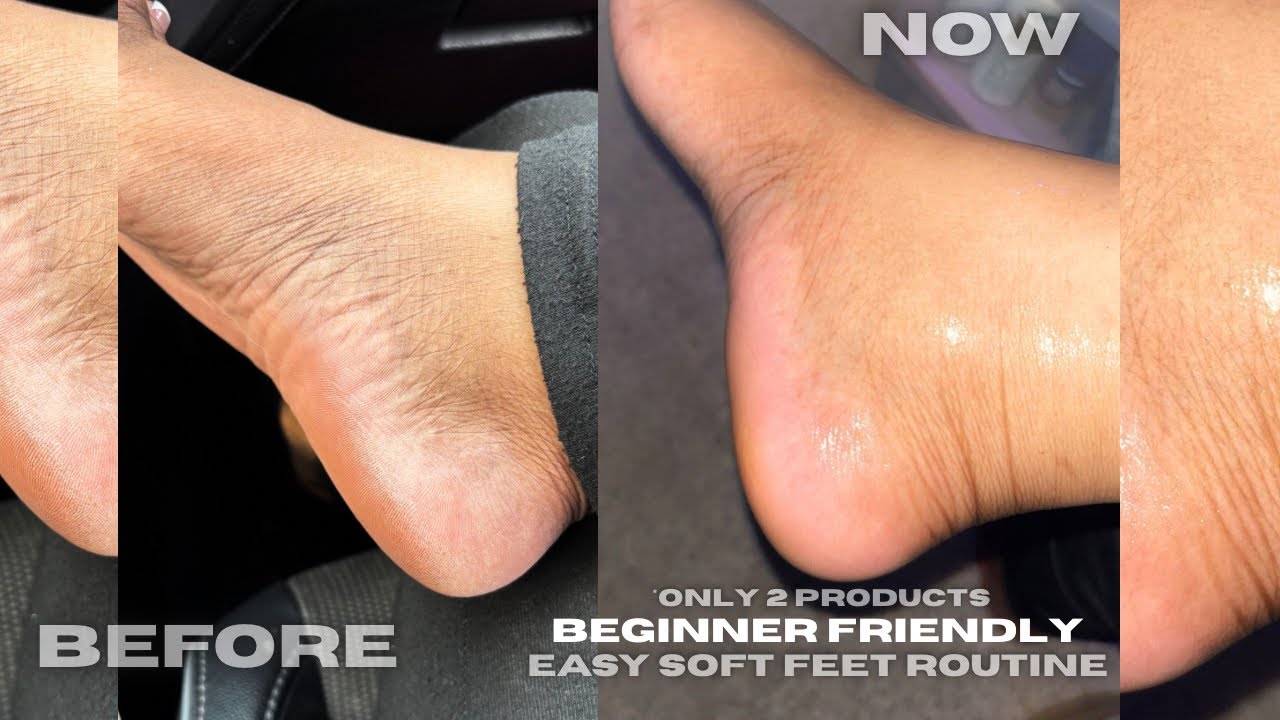 HOW TO GET RID OF CRACKED HEELS IN 3 WEEKS