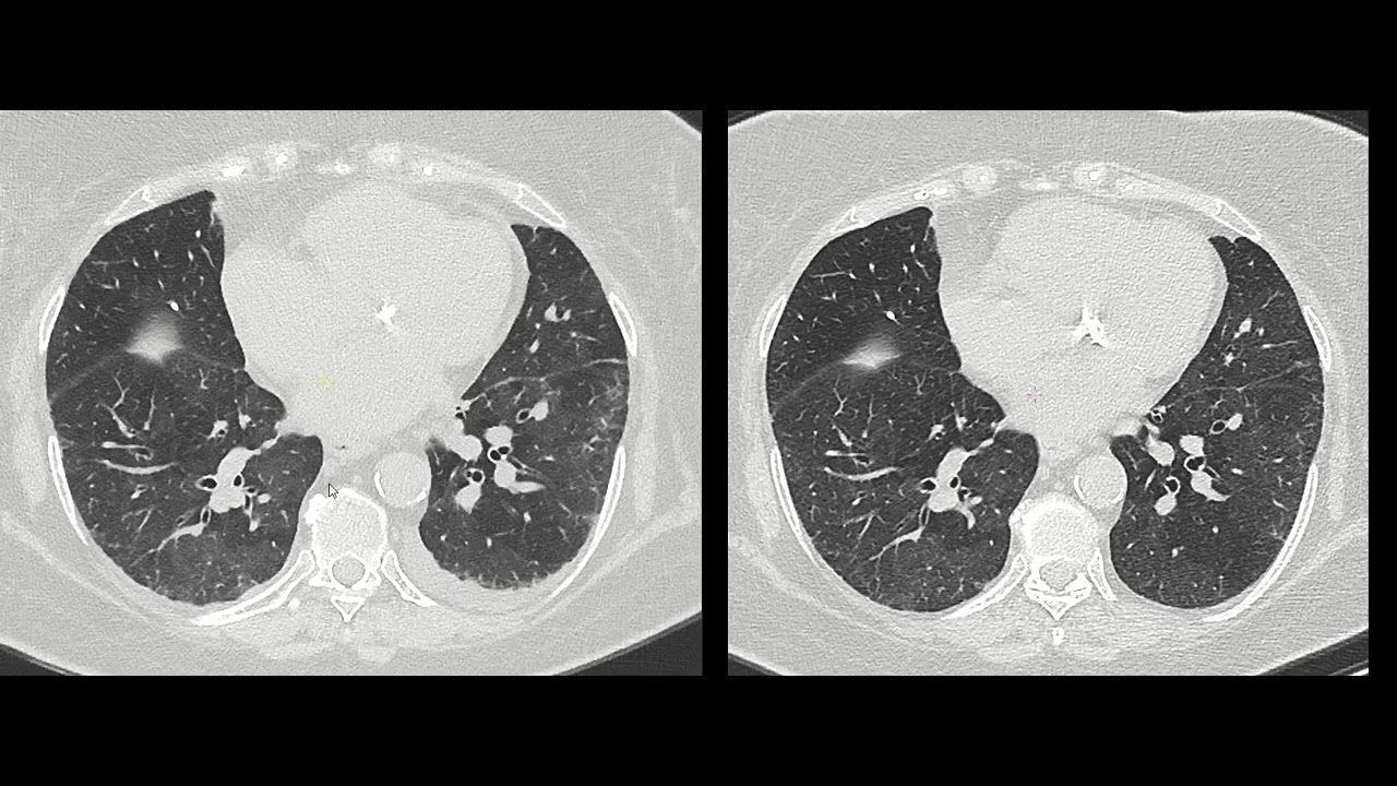 pulmoner hipertansiyon, anormal pulmoner venöz dönüş, akciğer ödemi