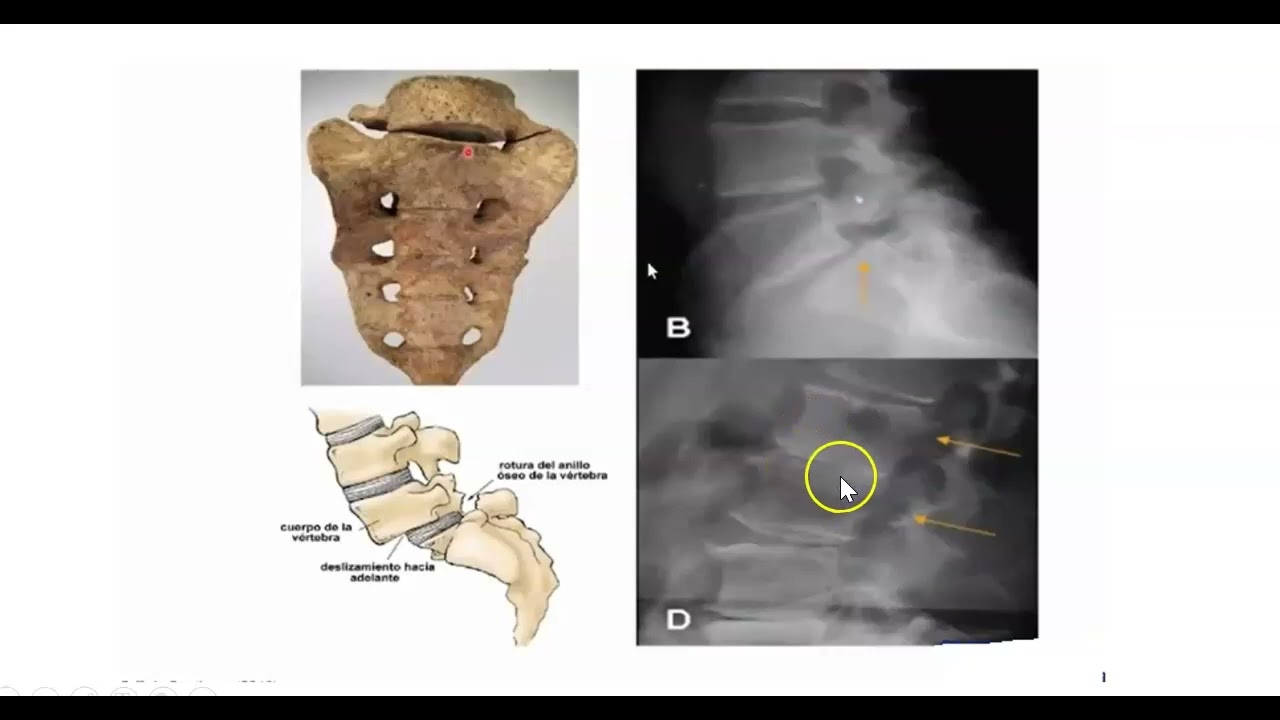 FSPTA 2022. FISIOPATOLOGIA DE LA ARTROSIS