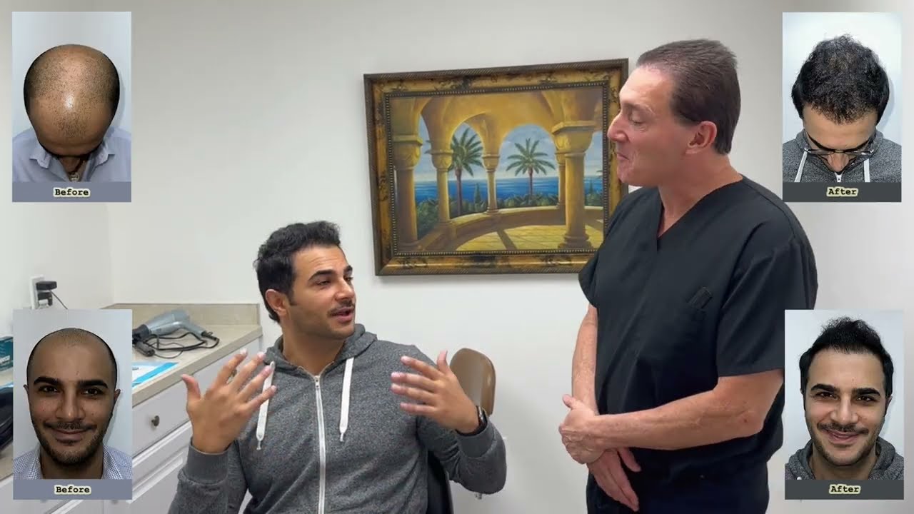 Dr. Brett Bolton performed another excellent Maxharvest Plus Hair Transplant for his patient Igor
