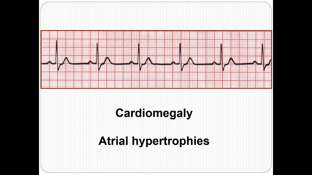 ECG Cardiomegaly - Atrial emlargenet 2018