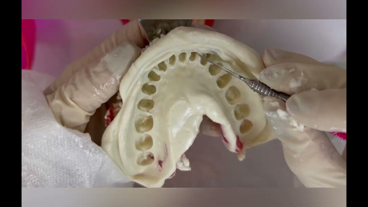 Moldagem em alginato e modelo em gesso