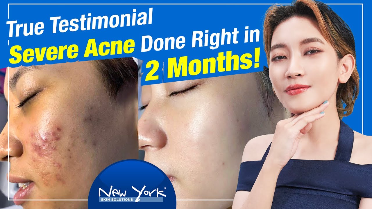 Severe Acne Done Right in 2 Months! | True Testimonial