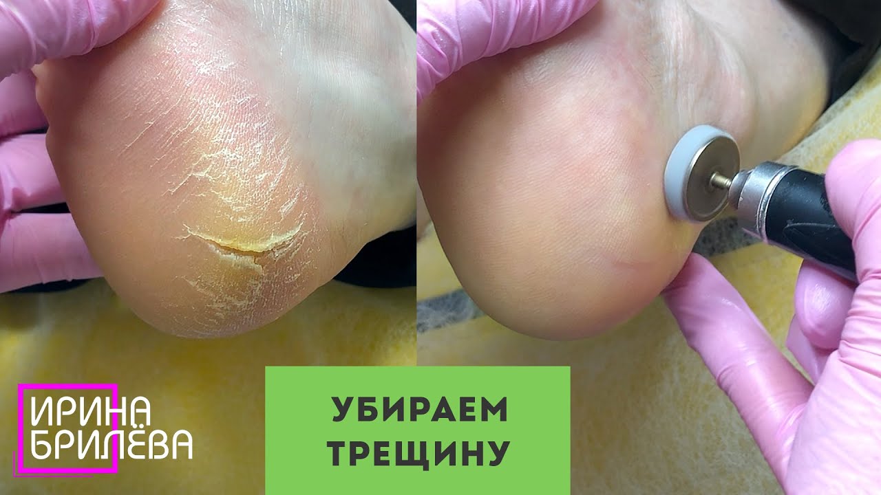 Глубокая ТРЕЩИНА НА ПЯТКЕ 🌸 Педикюр 🌸 Ирина Брилёва