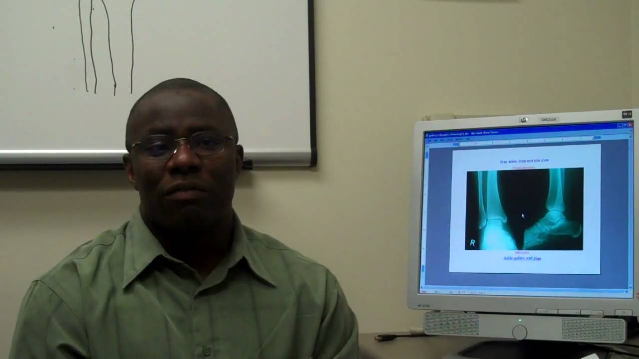 Shin Splints Pain | Dr. Ijeoma Nwaeze  | Orthopaedics | Sports Medicine | Milwaukee