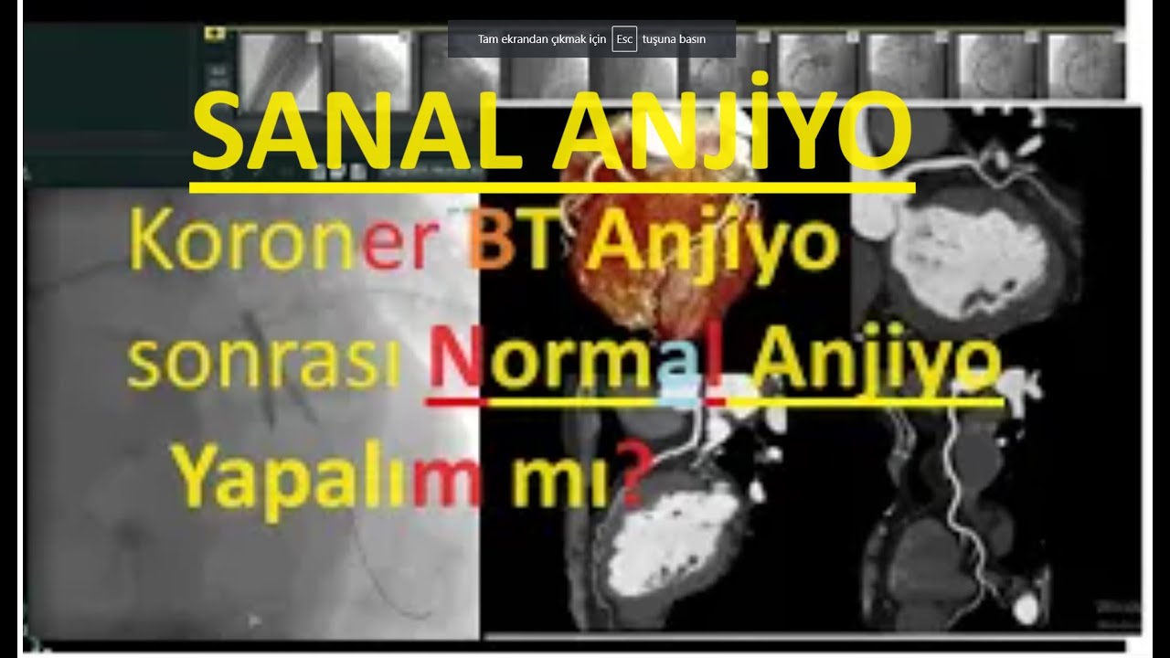 SANAL ANJİYO YETERLİ Mİ?