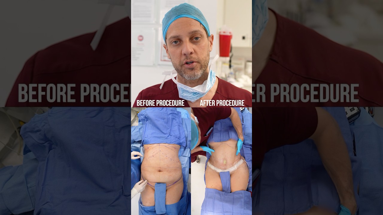 BEFORE & AFTER | 360 Lipo, BBL, Tummy Tuck #fyp #liposuction #lipo360 #bbl #bbljourney #fypシ #lipo