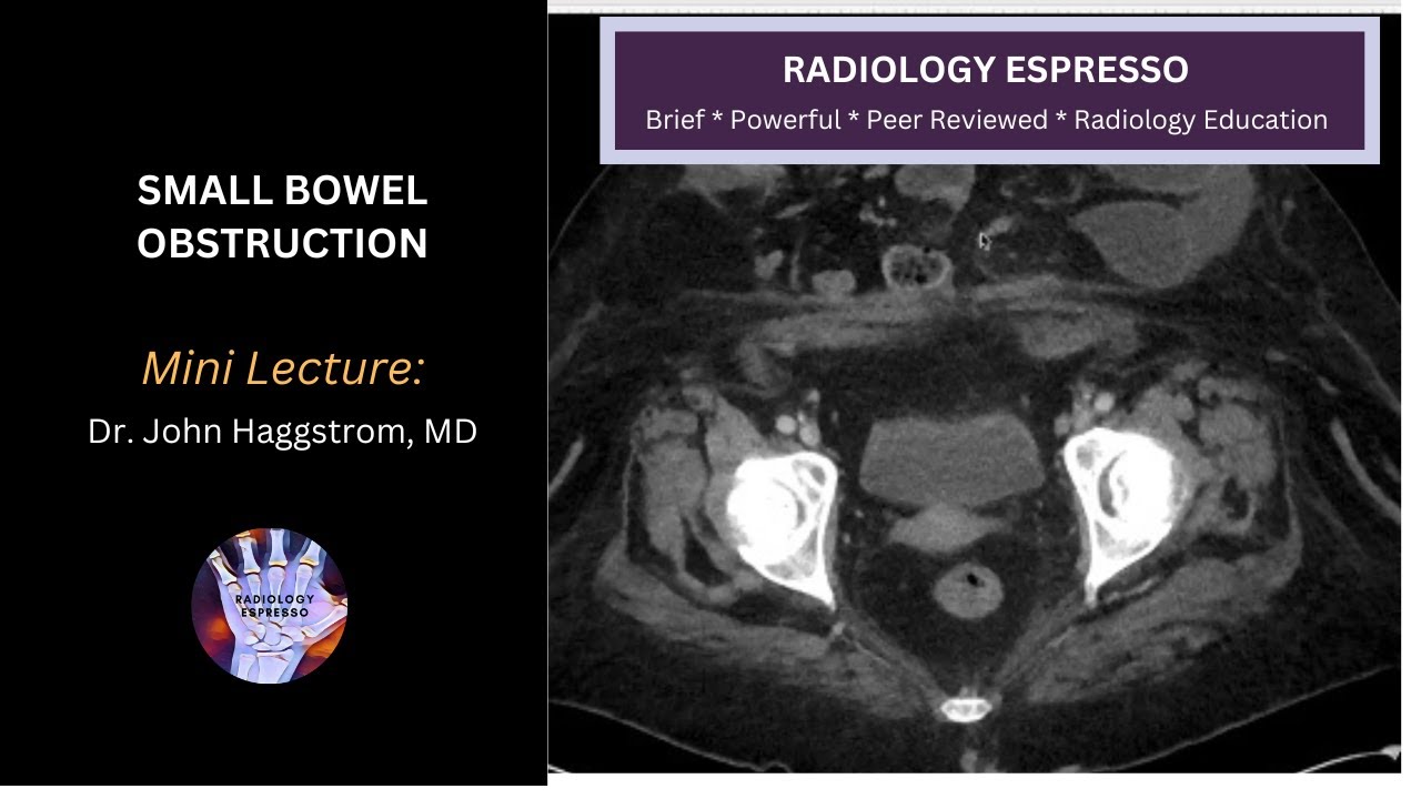 SMALL BOWEL OBSTRUCTION: Mini Lecture, Dr. John Haggstrom, MD