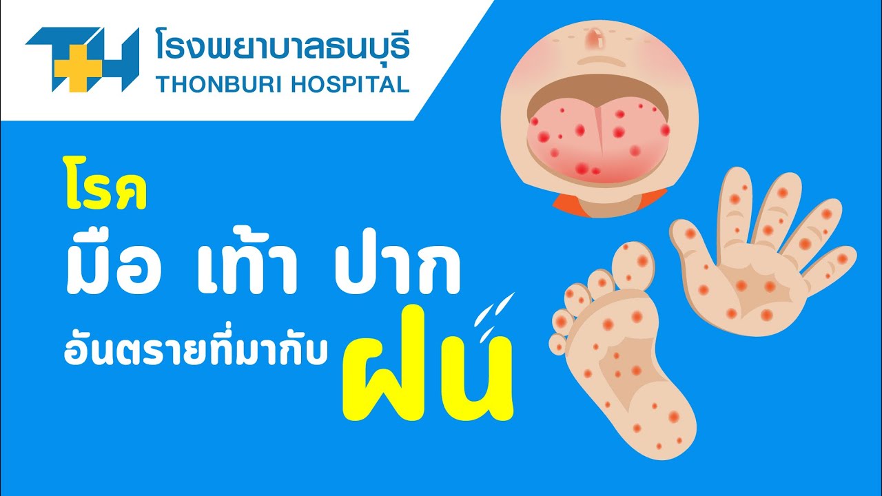 โรงพยาบาลธนบุรี :  มือ เท้า ปาก โรคระบาดในเด็กที่ต้องระวัง !!
