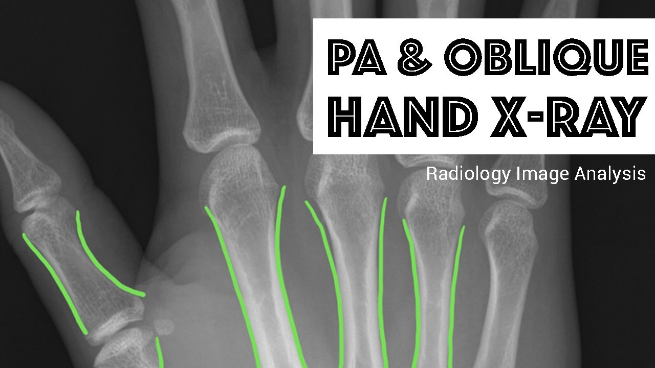 Radiology Image Analysis: PA & Oblique Hand X-Ray