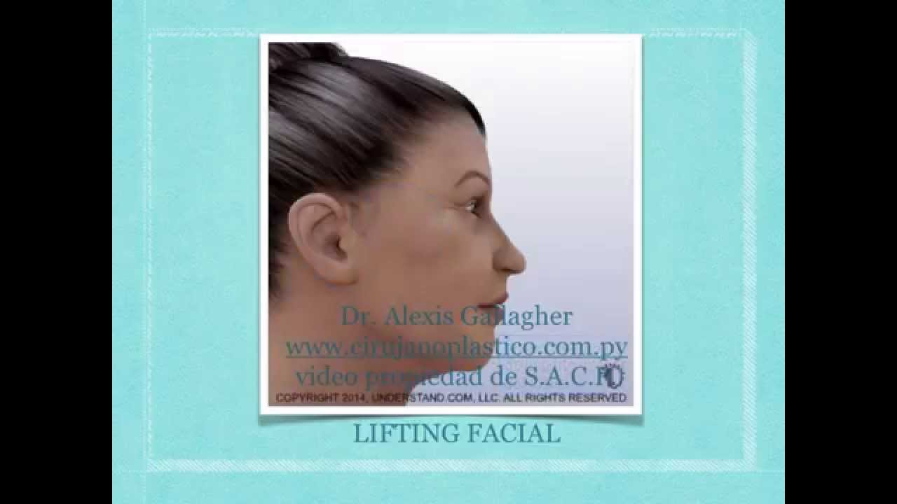 Estiramiento de cara y cuello ( lifting facial )