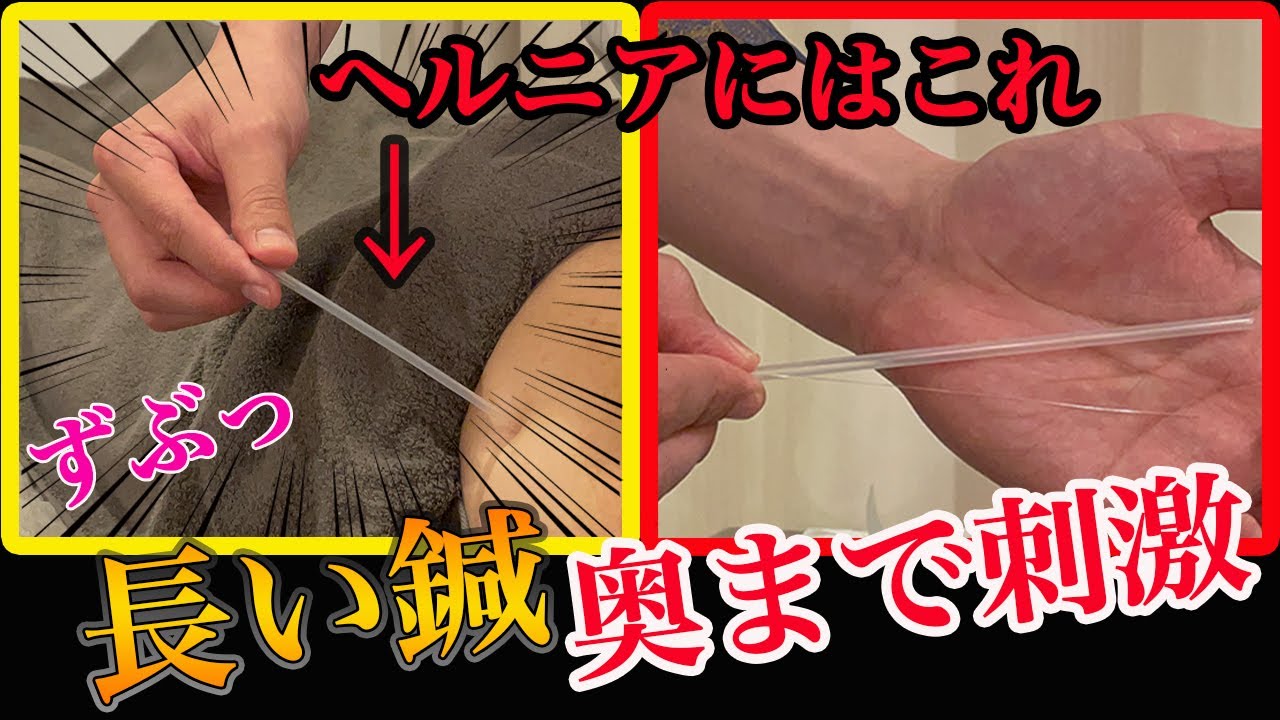 【札幌 ヘルニア】４０代男性の腰痛をスッキリ解消！美容鍼KINGの腰痛には長い鍼！ 【はり灸整骨みのりの森治療院 】