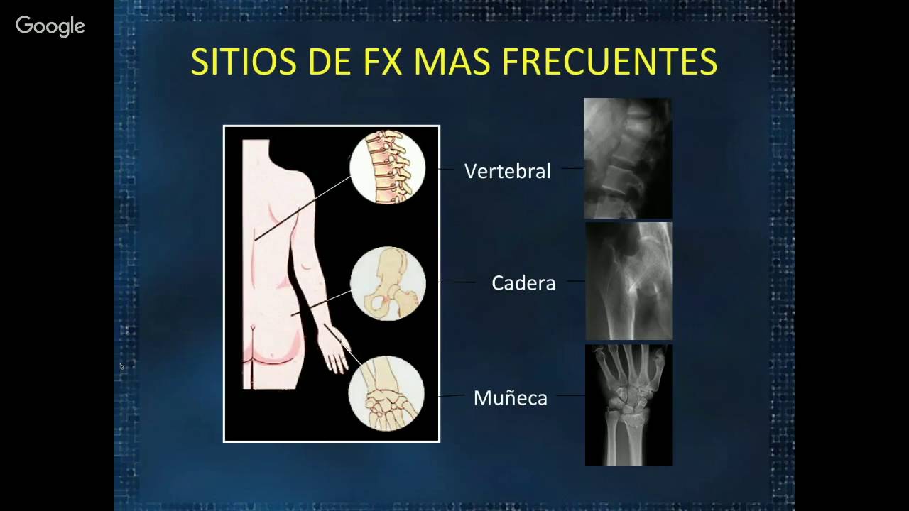 Osteoporosis