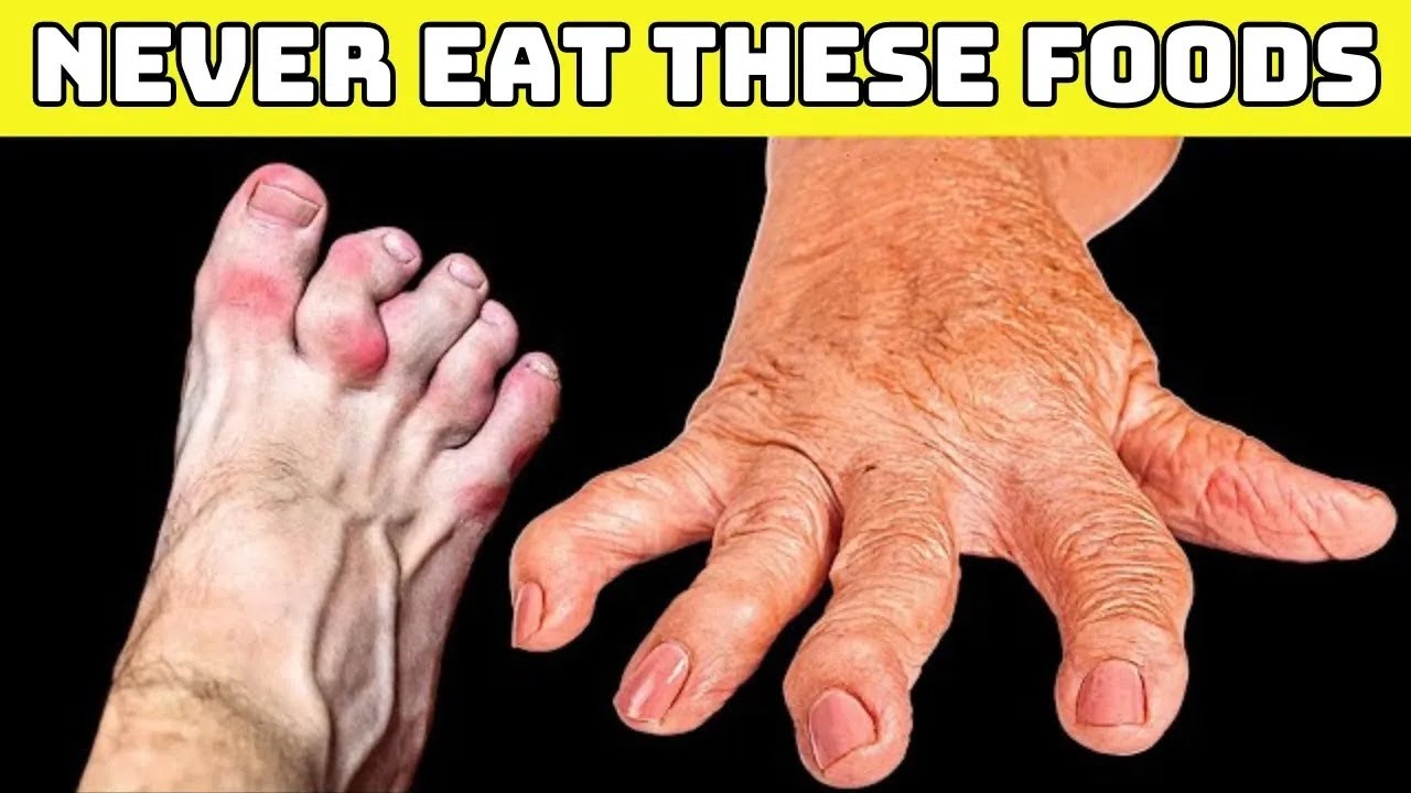 Top 10 Foods You Should NEVER Eat If You Have Arthritis