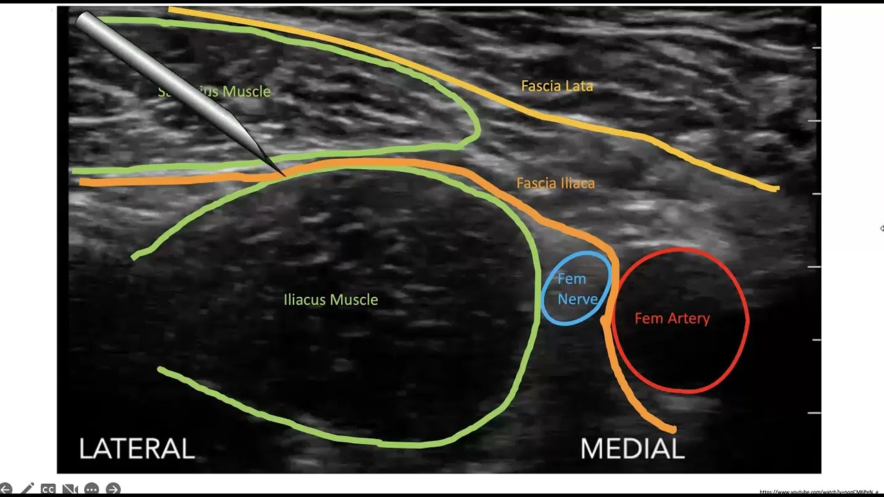 Ultrasound Guided Fascia Iliaca Block