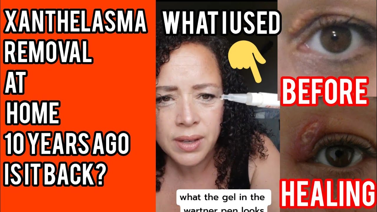 Xanthelasma Removal at Home 10 Years Ago Update | What Did I Use Is There a Scar | Has It Come Back