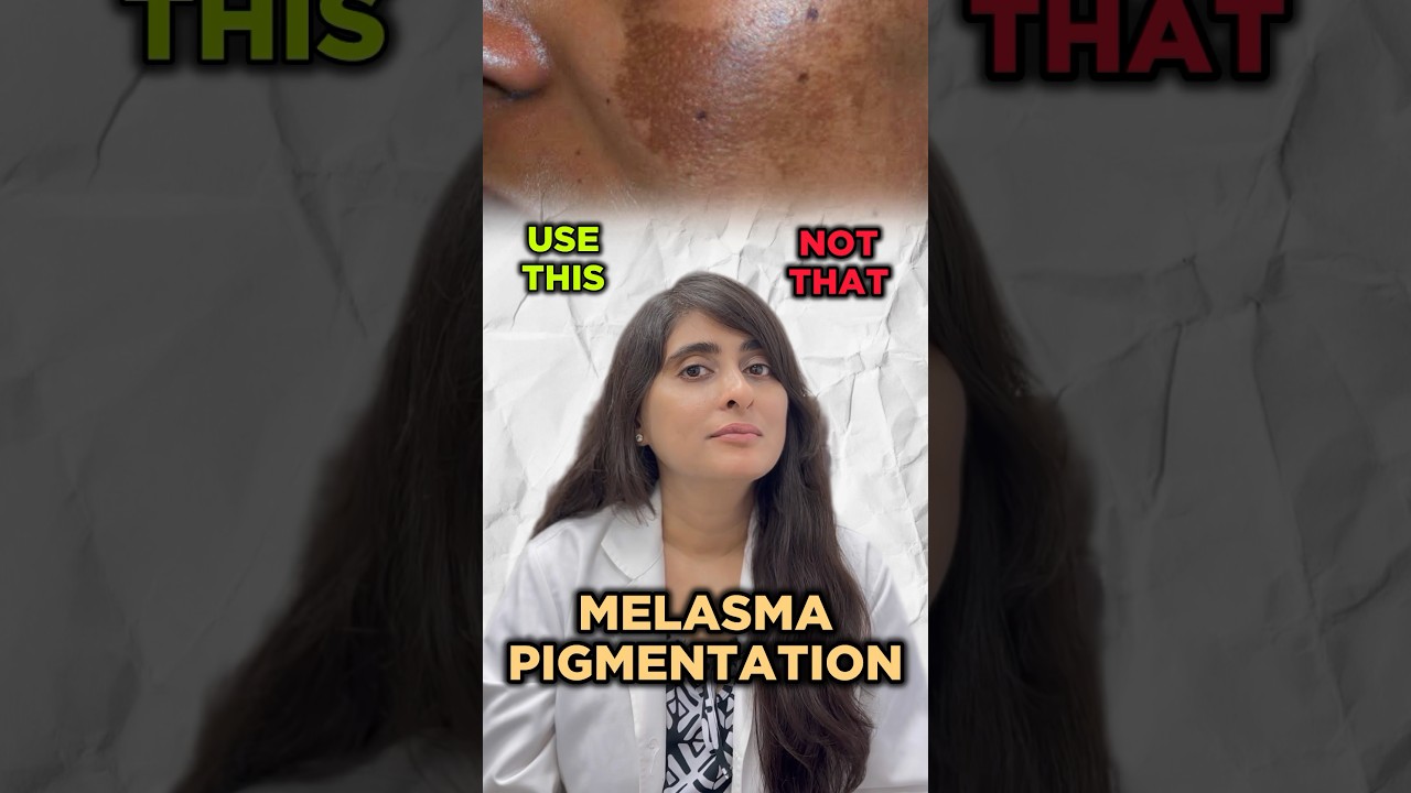 How to treat Melasma | Melasma treatment by dermatologist | Pigmentation | Pigmentation on face