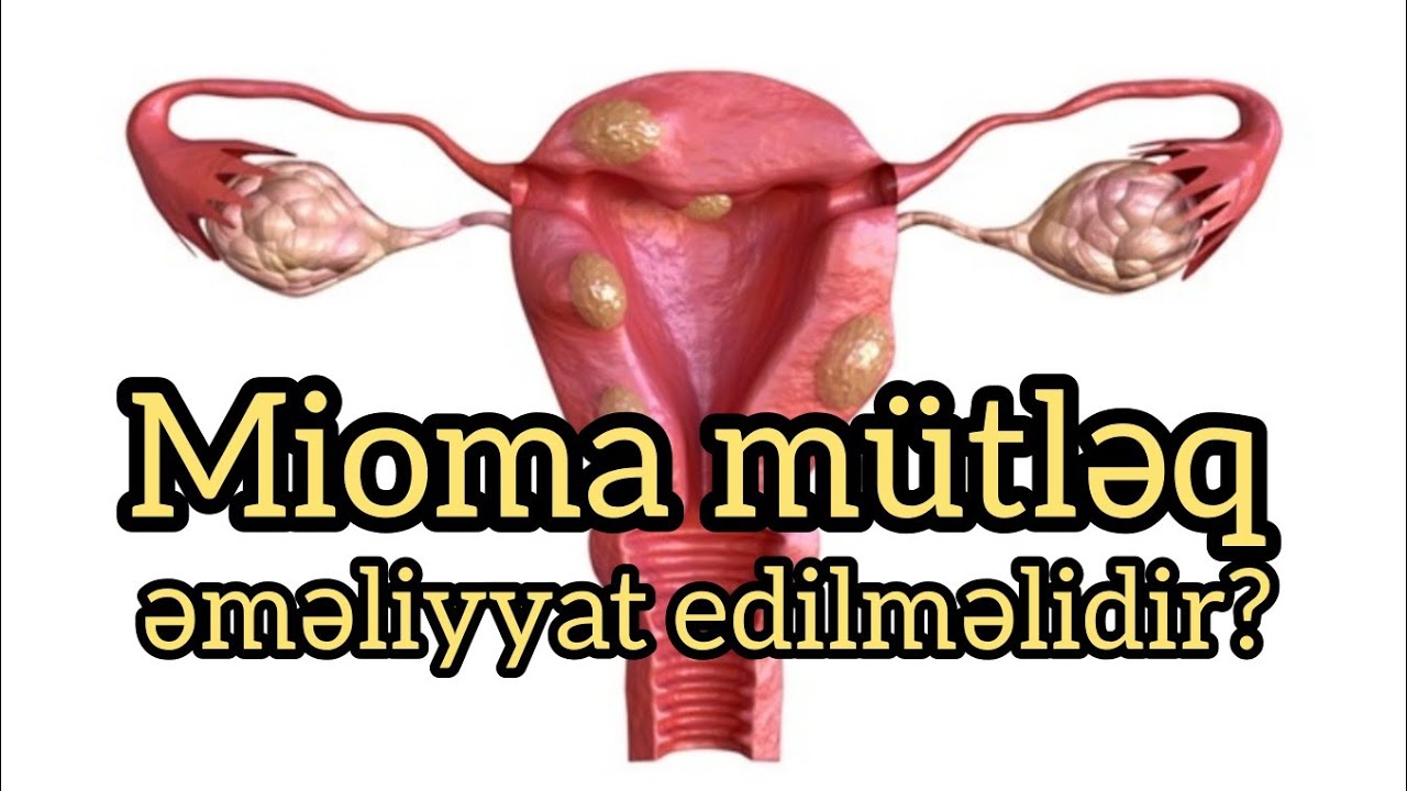 Mioma mütləq əməliyyat edilməlidir?