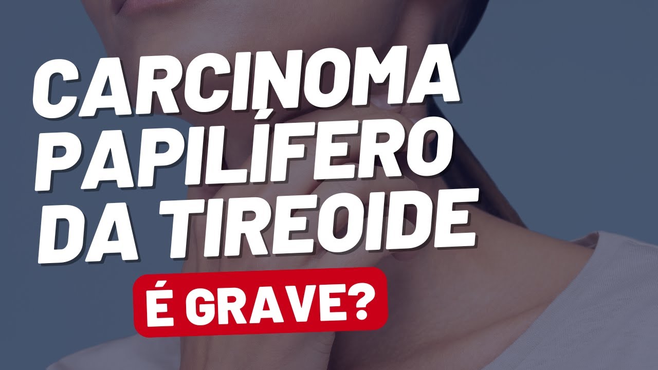 Carcinoma Papilífero de Tireoide: o Câncer Mais Comum da Tireoide!