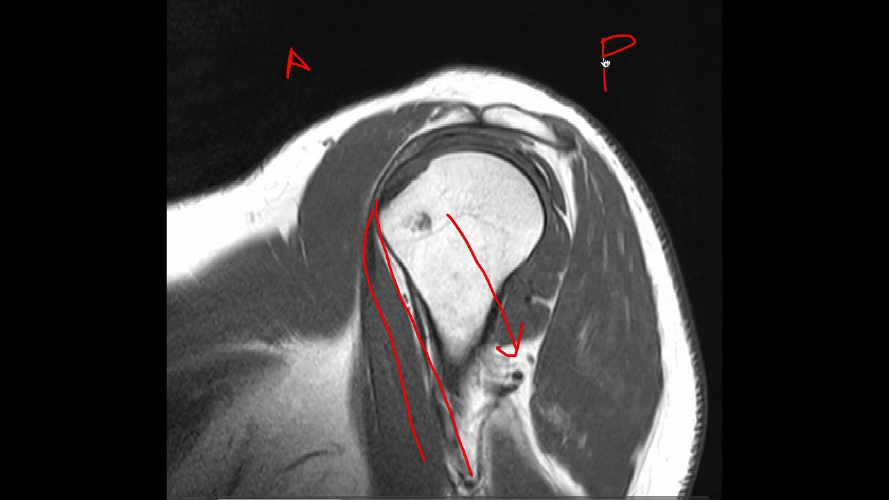 Anatomía RM hombro
