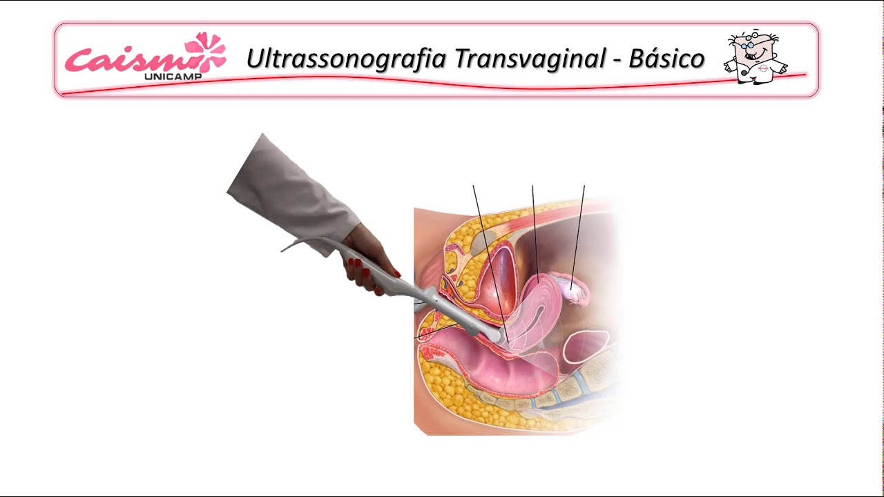 Fundamentos da ultrassonografia transvaginal