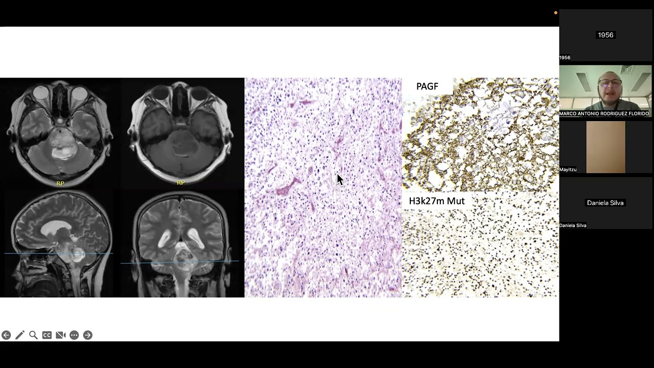 Glioma difuso de la línea media, difuso hemisférico & difuso de alto grado de tipo pediátrico