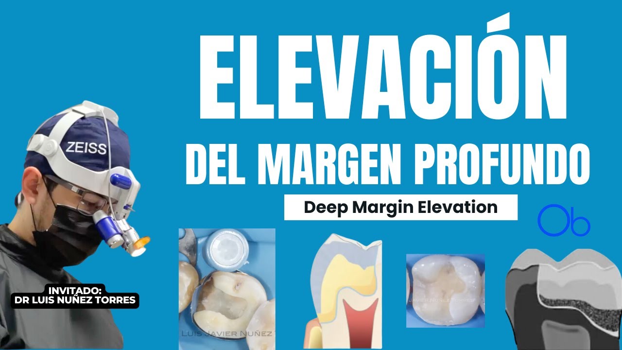 Elevación de margen profundo 🦷 con Dr Luis Javier Nuñez Torres