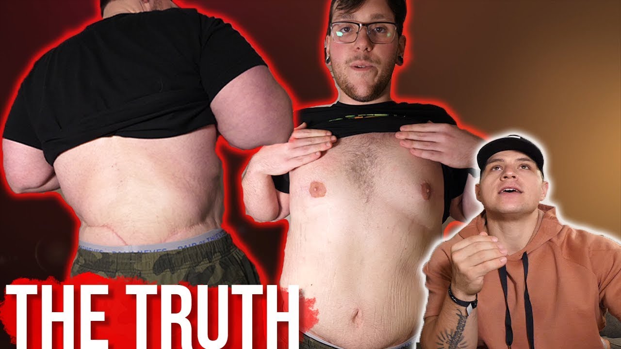 The TRUTH About Loose Skin Surgery...