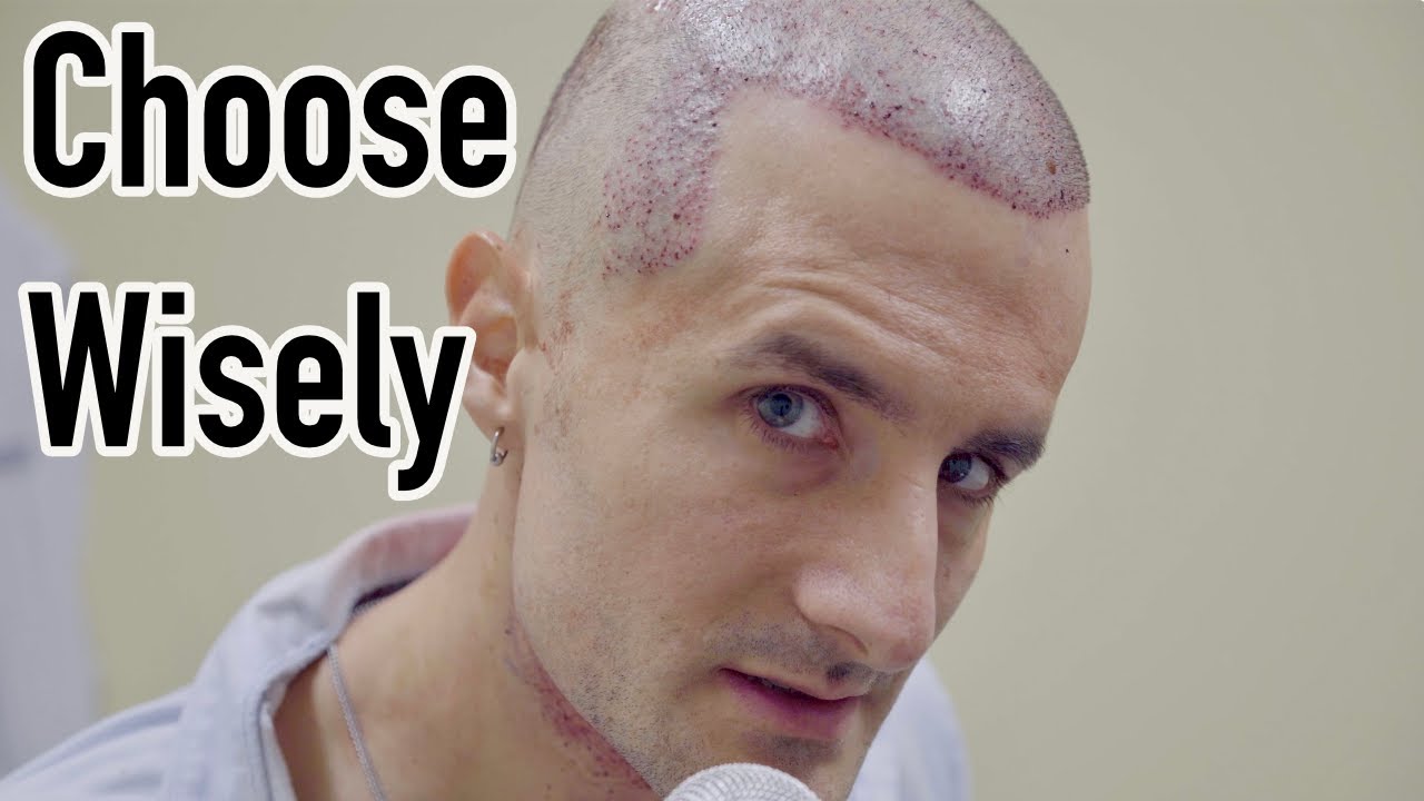 Why Your FUE Hair Transplant will FAIL by Dr. Mwamba