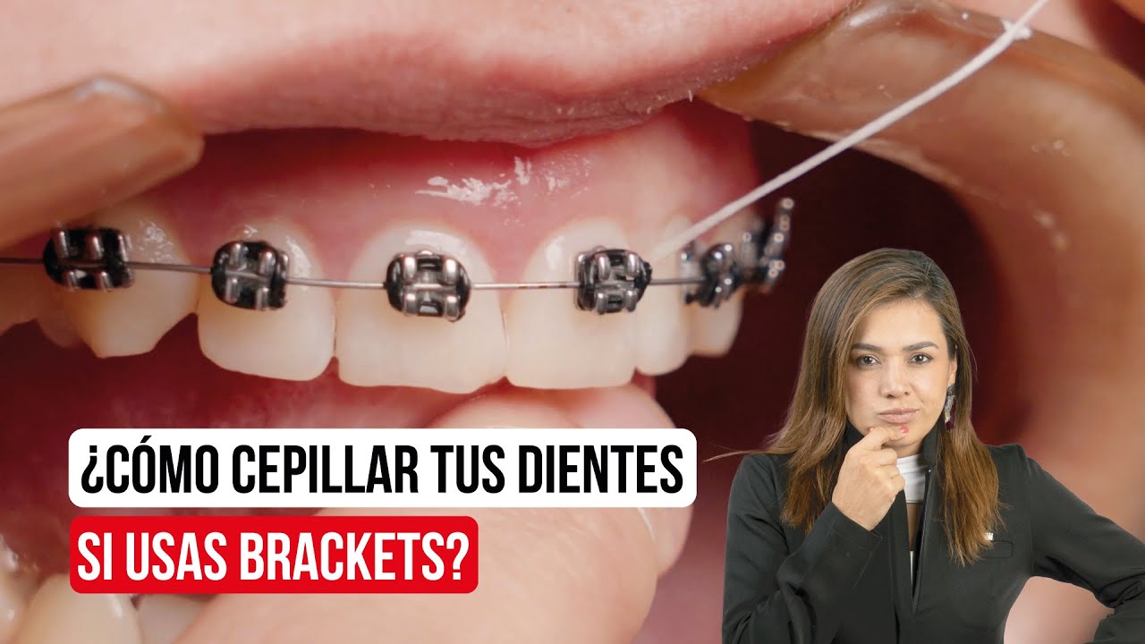 ¿Cómo me cepillo si tengo brackets? 🤔