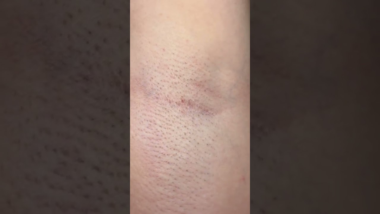Braun Ipl Skin I·Expert, At Home Laser Hair Removal