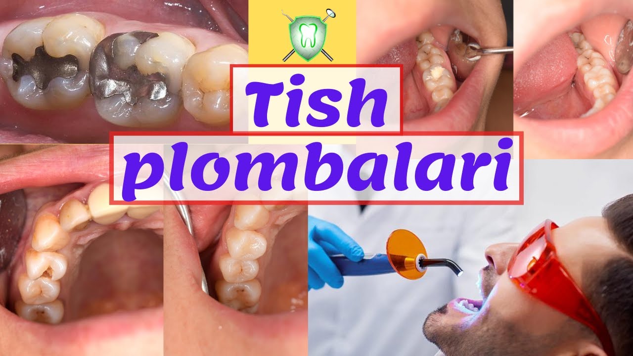 Tish plombalari ichida eng yaxshisi? Тиш пломбалари ичида энг яхшиси?