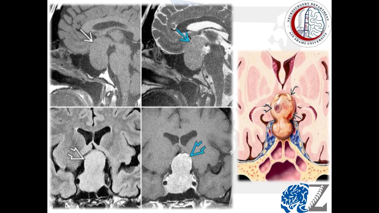 Brain Tumours (45):  Pituitary Adenomas (4):  Evaluation/Investigations  أورام الغدة النخامية