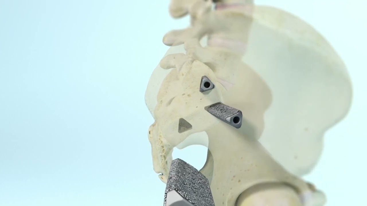 iFuse 3D&trade; Implant System - Animation