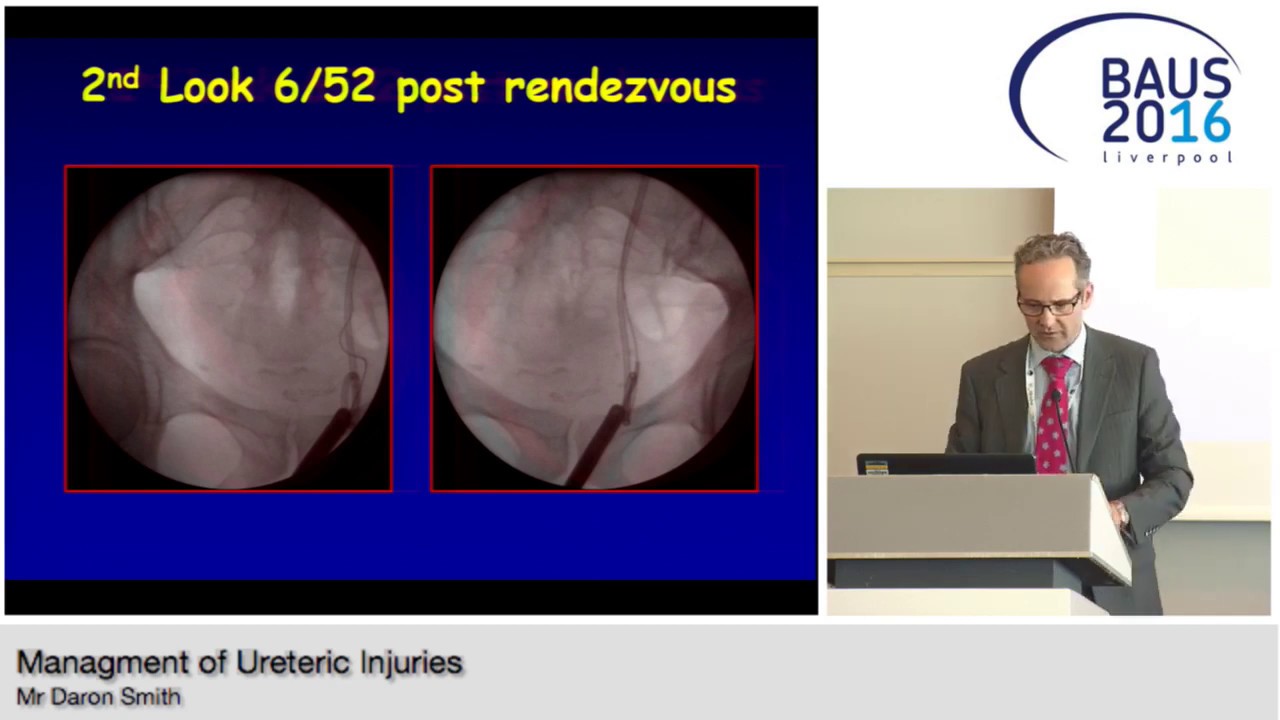 BAUS16 Managment of Ureteric Injuries