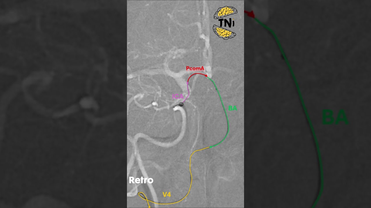 Basilar Occlusion: Retrograde Vertebral Access When Antegrade Fails