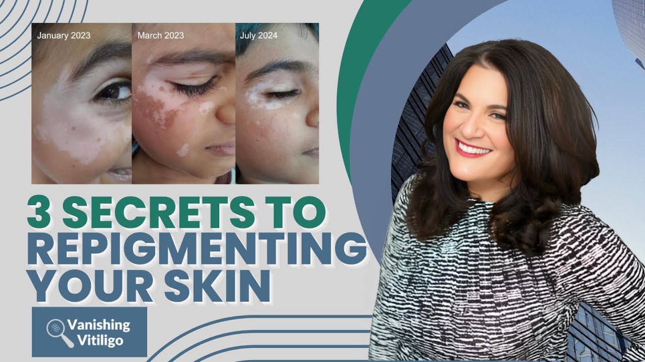 3 Secrets To Repigmenting Your Skin- Vitiligo Success
