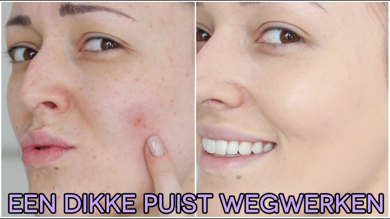 Een dikke puist wegwerken | Beautygloss