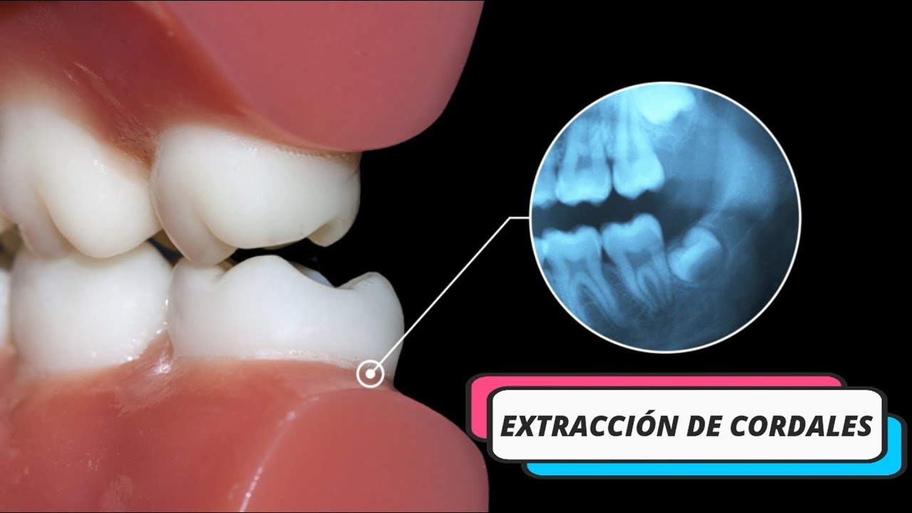 Cirujana especialista: Extracción Cordales  / Maxilofacial,  ¿En qué casos se requiere esta cirugía?