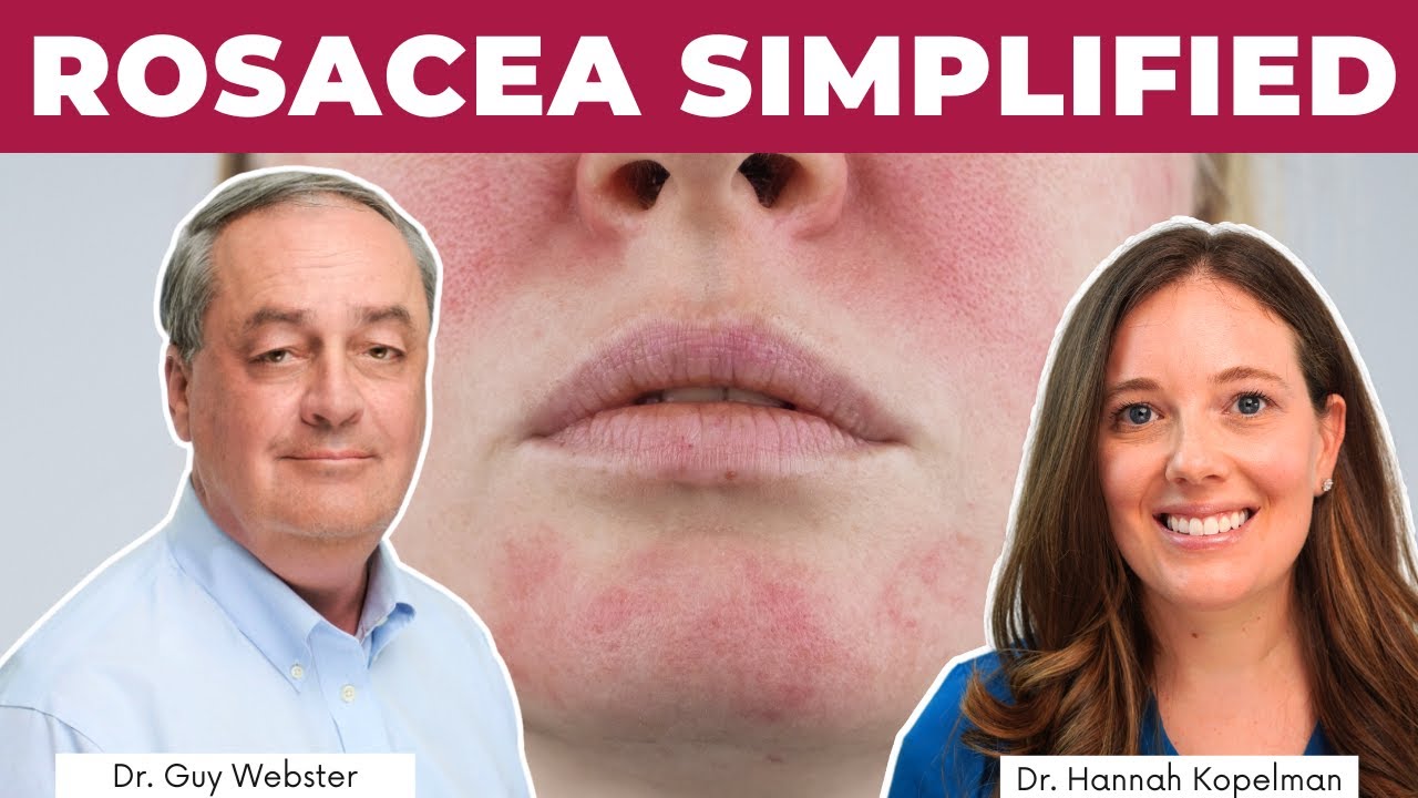 How to Treat Rosacea  | Dr. Guy Webster
