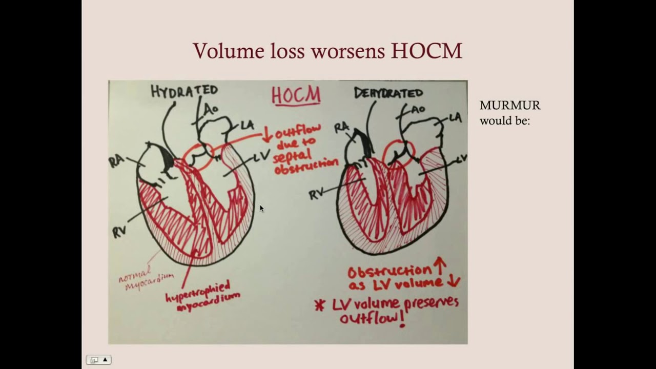 Cardiomyopathies - CRASH! Medical Review Series
