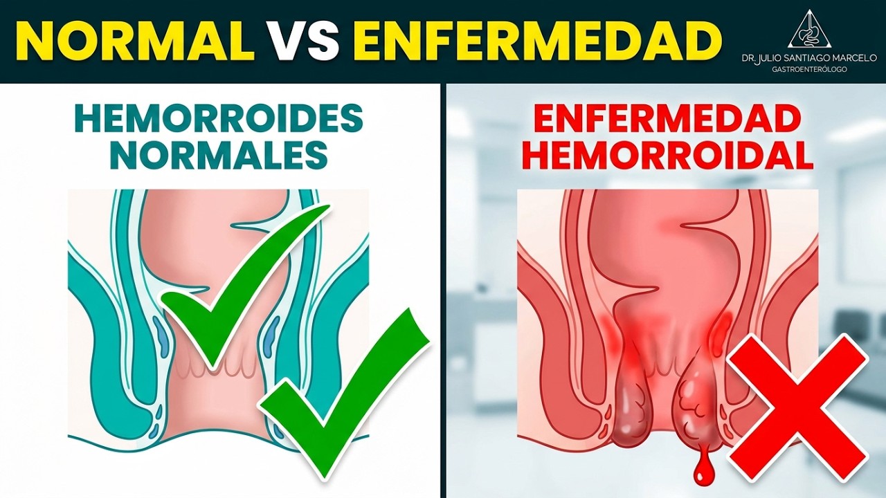 ¿Tienes hemorroides o enfermedad hemorroidal? Descúbrelo con el Dr. Julio Santiago Marcelo
