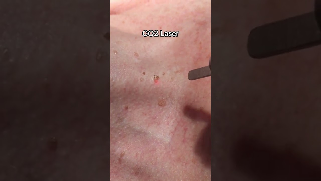 Mole Laser Removal ✨ #laser #moleremoval #satisfyingvideo