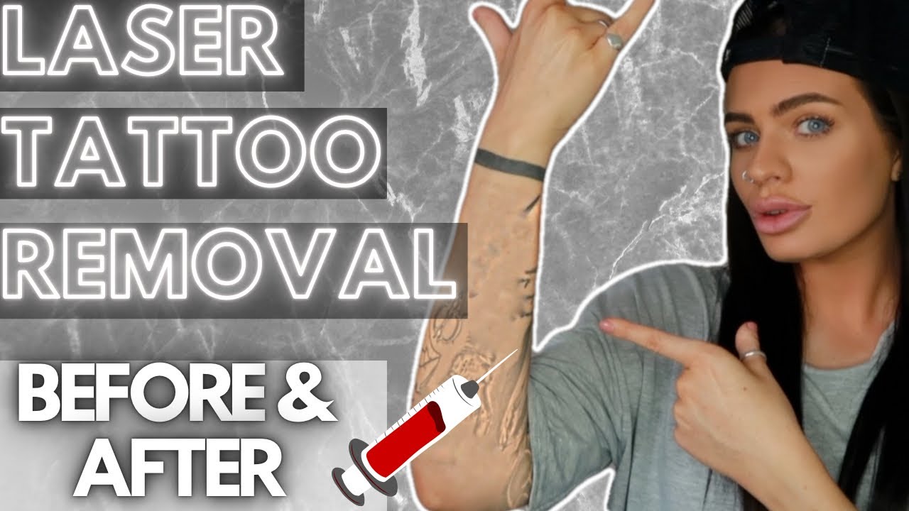 LASER TATTOO REMOVAL EXPERIENCE 💉- Before & After / FAQ's