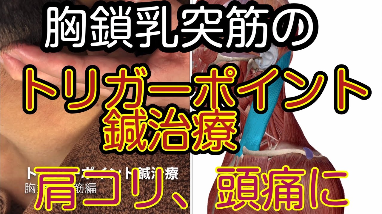 胸鎖乳突筋のトリガーポイント鍼治療、肩こり、頭痛の針治療